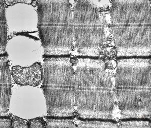 F,32y. | muscular dystrophy - steatosis